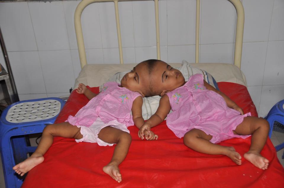  Doctors are examining the girls to see how much of a skull they share, and if their brains and blood vessels are also shared