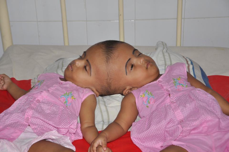  Twin girls Rabia and Rukia were born with the tops of their heads fused together