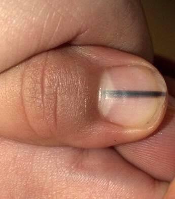 Black lines on nails are in line with NHS advice on subungual melanoma,  a form of skin cancer that affects the nail bed.