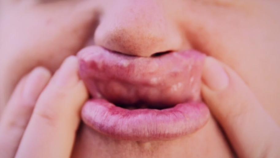  The botched procedure left Rachel with 13 pea-sized lumps across her upper and lower lips