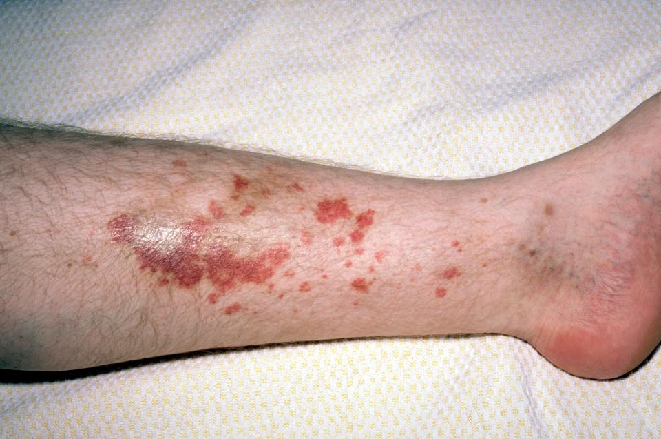  Mycosis fungoides appears as a patchy red rash in its early stages