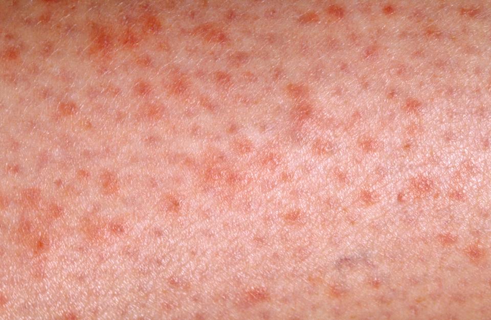  Petechiae is caused by broken blood vessels under the skin