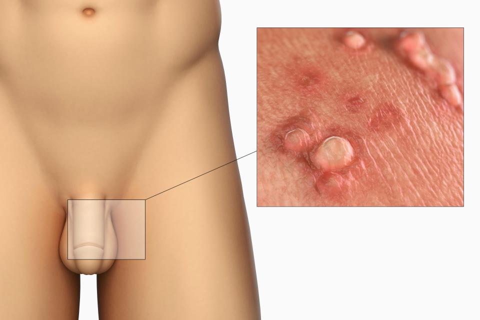  Genital warts are the second most common STI in the UK and cause small, fleshy growths to appear on the genitals