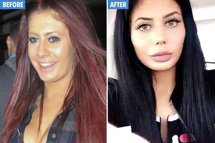  Geordie Shore's Chloe Ferry before and after surgery