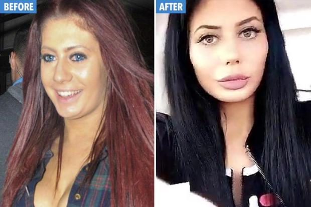 Geordie Shore's Chloe Ferry before and after surgery