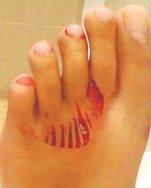  A girl was left with deep wounds to her foot after the suspected shark attack