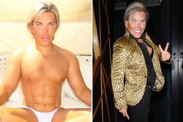 Human Ken Doll Rodrigo Alves is getting six ribs removed