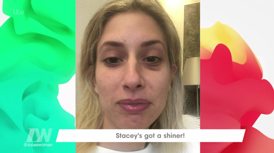  Stacey Solomon revealed she got a black eye while playing with her kids over the weekend