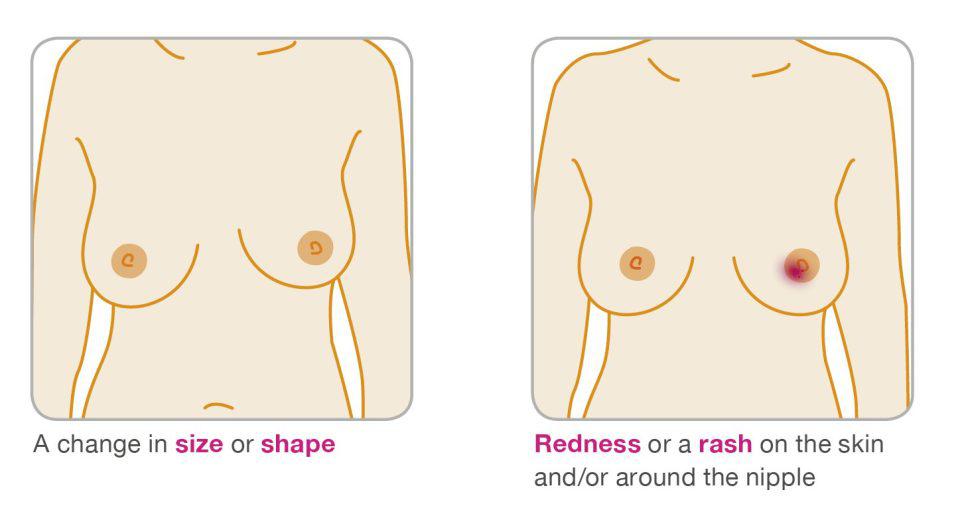  Changes in your breast size or shape can be a sign of cancer