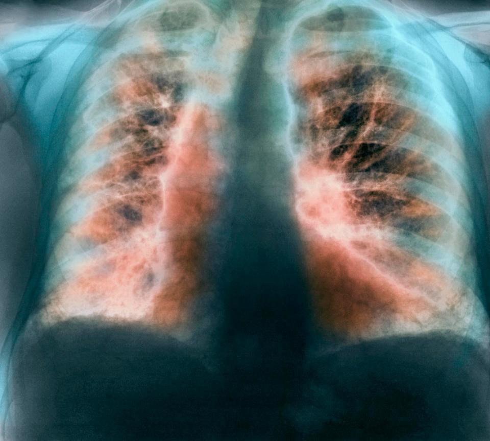  Sufferers have scarred alveoli (air sacs in the lungs), and this causes them to become stiff