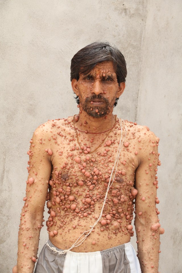 Surinder Sharma is covered in thousands of tumours