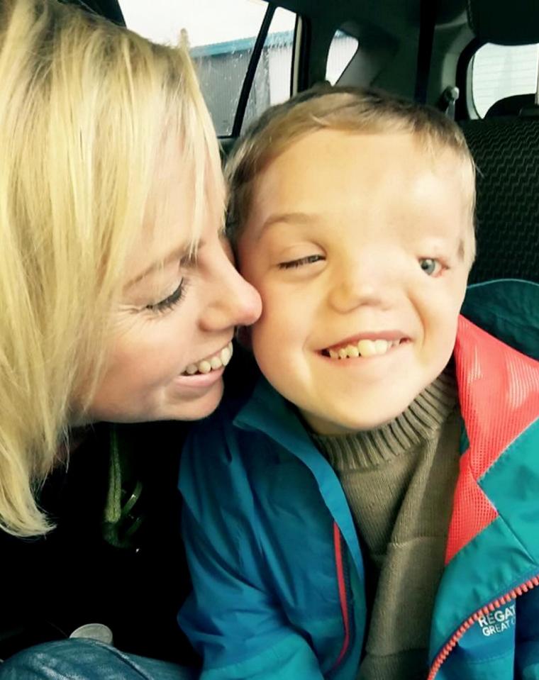  Brave Harry Beswick was born with Goldenhar syndrome, which means he has no left eye, eye socket, nostril and left ear