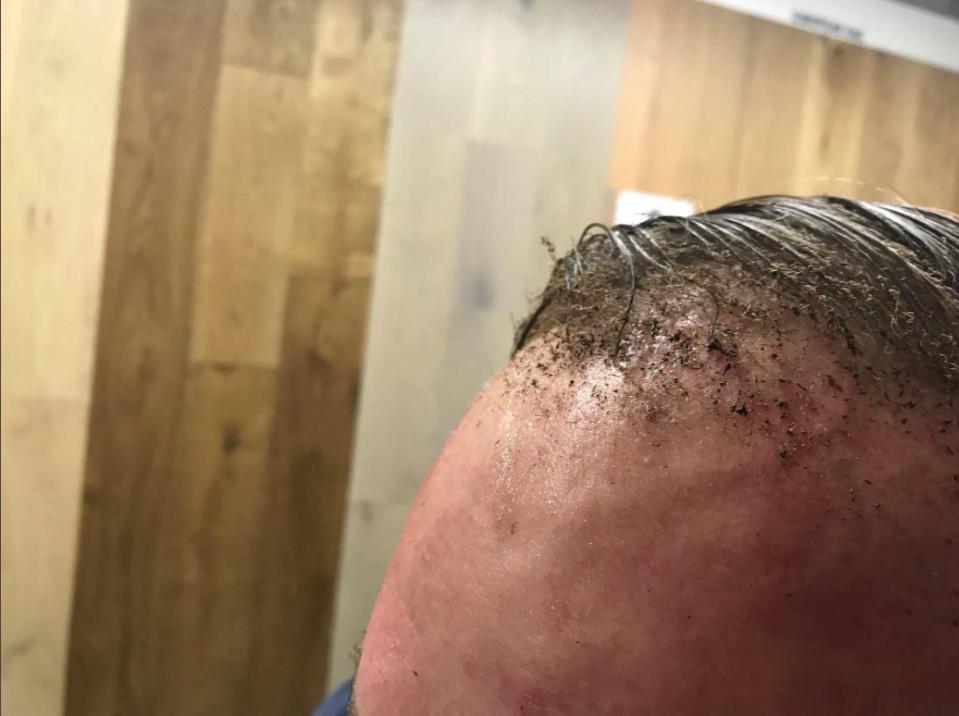  One man posted pictures of his injuries after the explosion - where his hair appeared to have been burnt