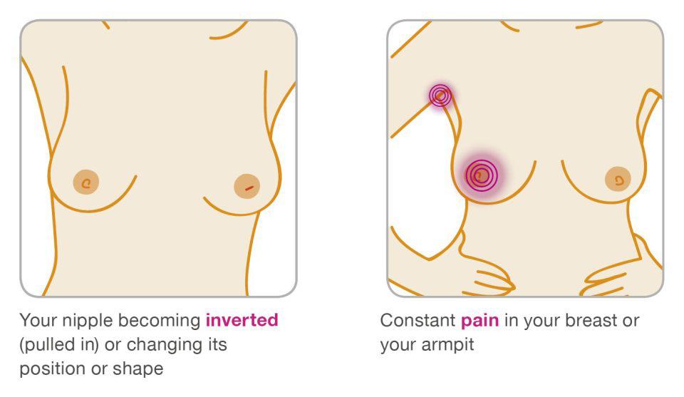  An inverted nipple can be a sign of breast cancer