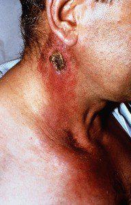 Nightmare symptom ...the telltale Anthrax rash