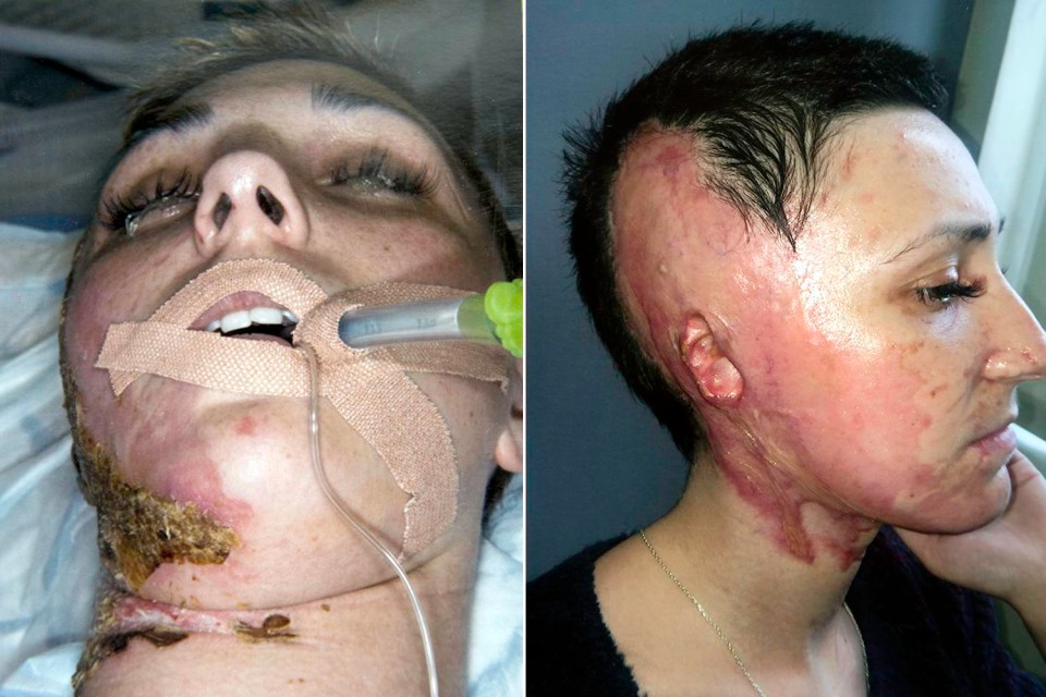 Adele was left scarred for life and lost an ear after her ex boyfriend arranged to have sulphuric acid hurled in her face