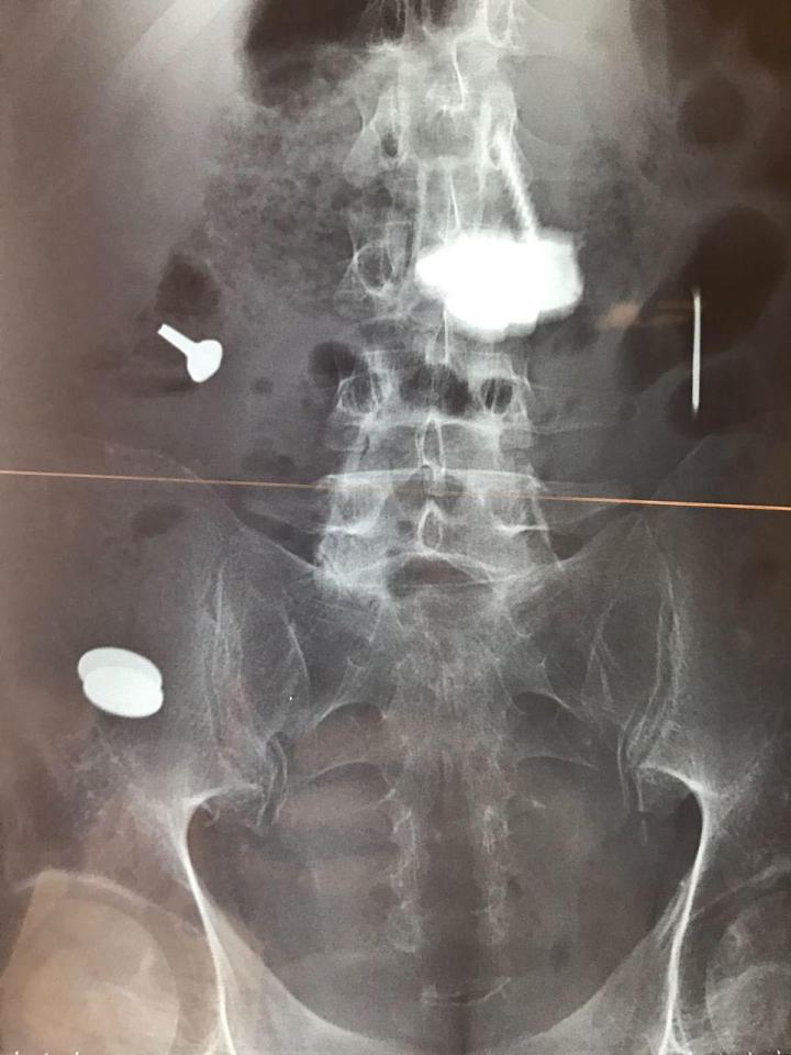  The man swallowed pieces of metal so frequently that they formed what is called a bezoar - an accumulation of of foreign bodies in the stomach