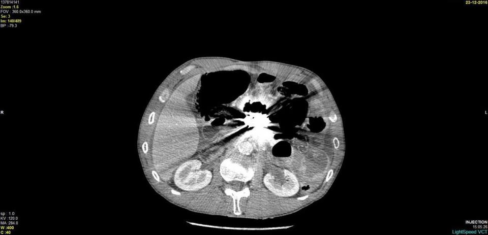  On his last visit to hospital in December last year scans revealed the metal had pierced his stomach and caused the lining, called the peritoneum, to become inflamed. He was also septic