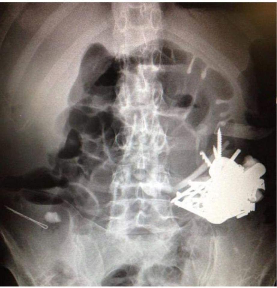  The accumulation of metal pieces was blocking the man's digestive tract