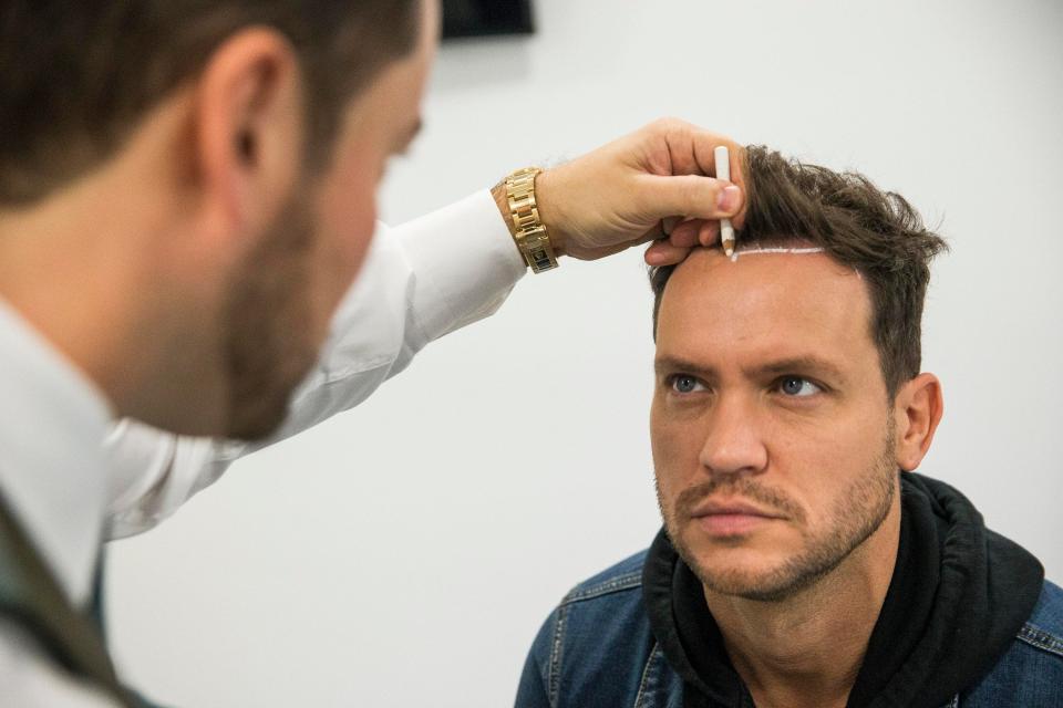  A doctor drew a line where his ideal hair growth would appear before the op