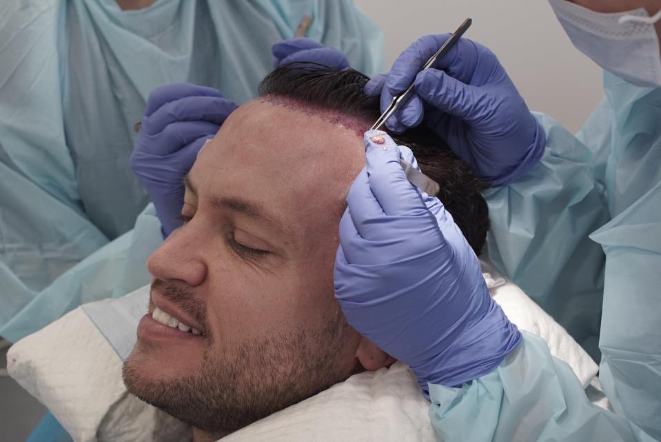  Jamie Reed has shared the whole process of his hair transplant via often gruesome pics