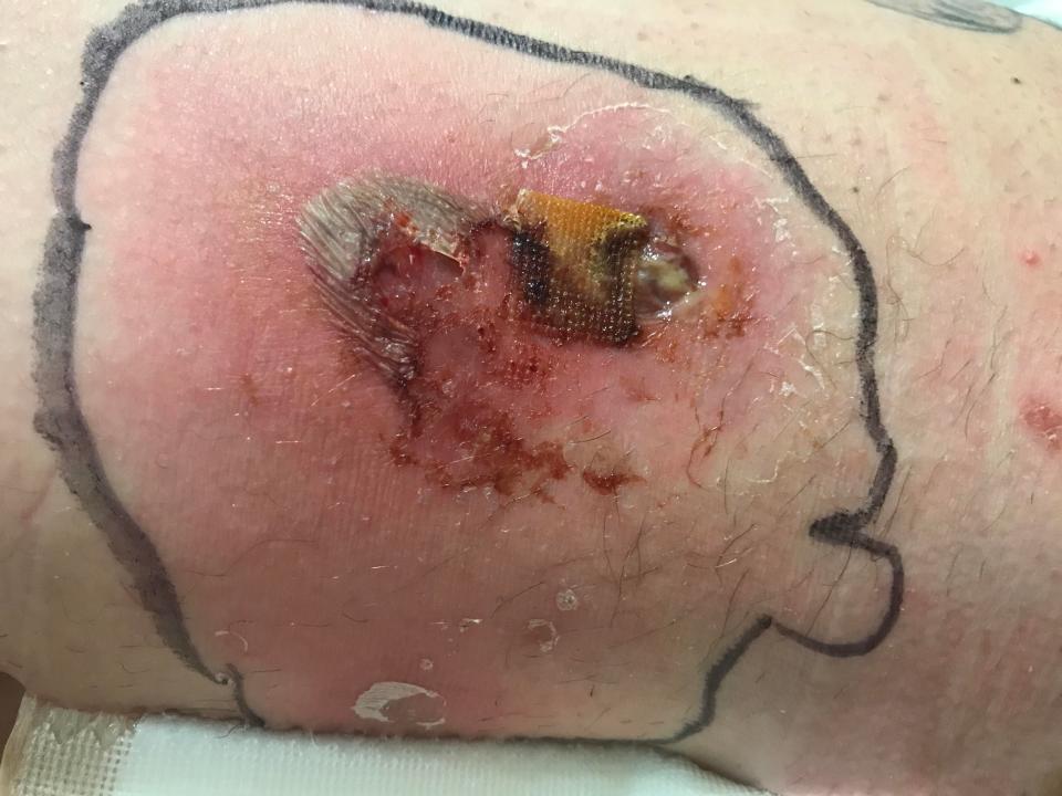  An abscess developed under her skin following the bite