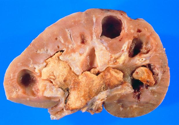 A cross section of a removed kidney showing the position of some huge kidney stones