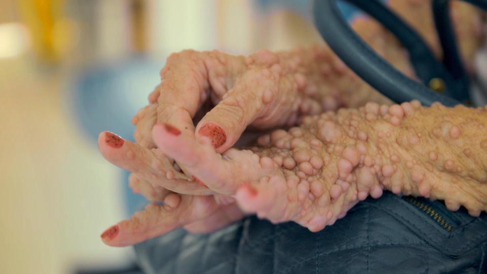  The 53-year-old suffers a condition called neurofibromatosis type 1