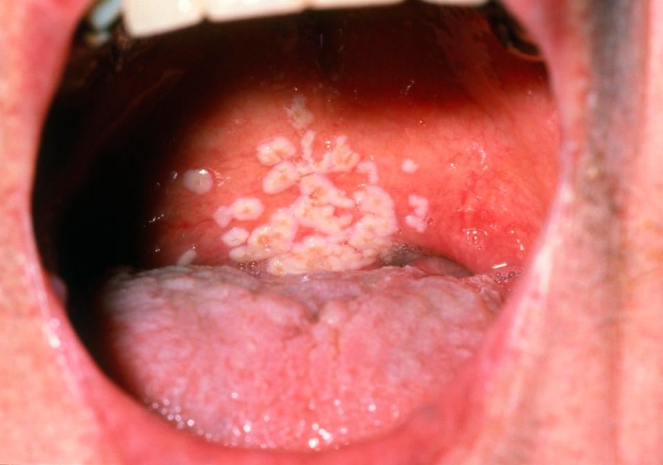  Oral thrush is a fungal infection in the mouth