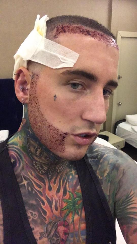  Jeremy showed off the results of his surgery - and a new cross tattoo on his cheek