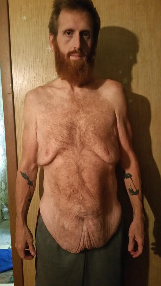 Zach had two stone of horrific skin hanging off his body after his weight-loss surgery