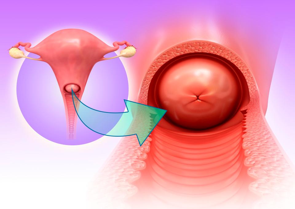 Cervical ectropion causes more fragile glandular cells to grow on the outside of the cervix