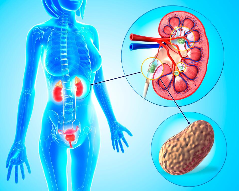  A diagram showing the position of the kidneys and a stone about to start its journey down the ureter