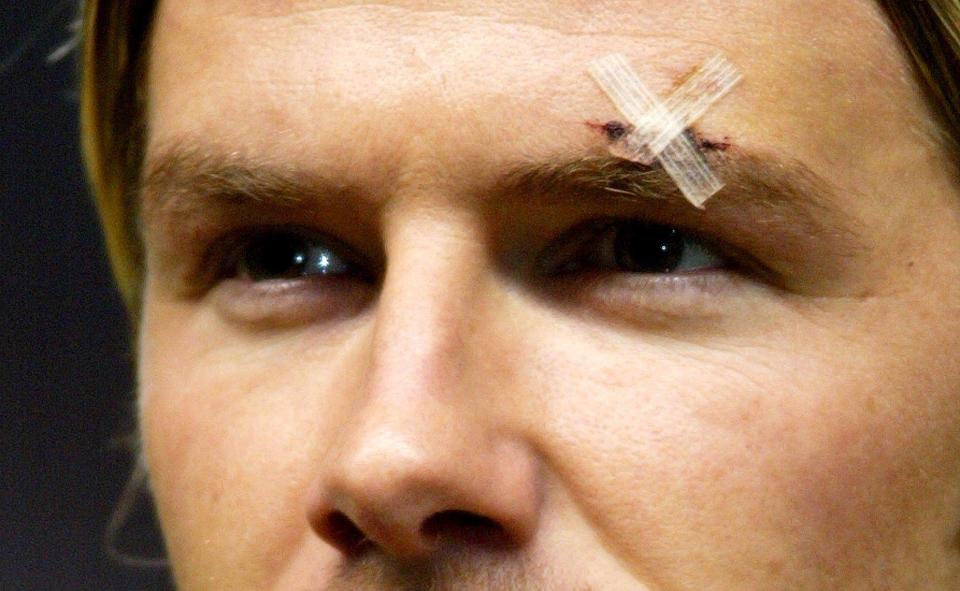  David Beckham needed stitches after the dressing-room incident