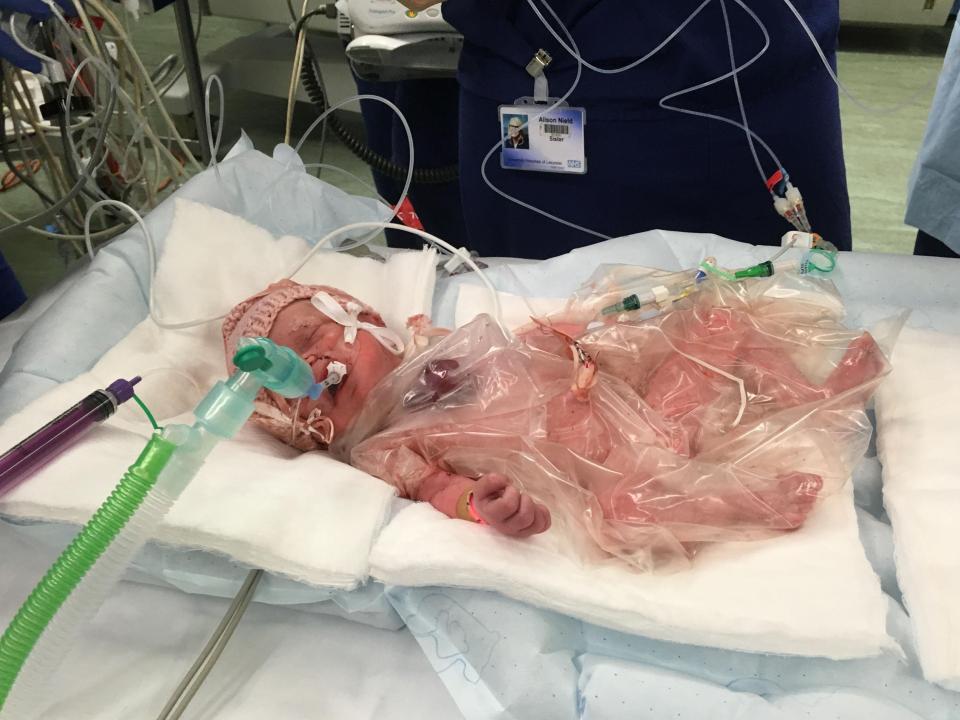  The tot underwent her first surgery 50 minutes after being born