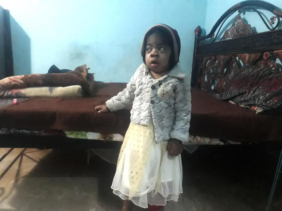  Her parents hope she will one day receive surgery to remove the hernia