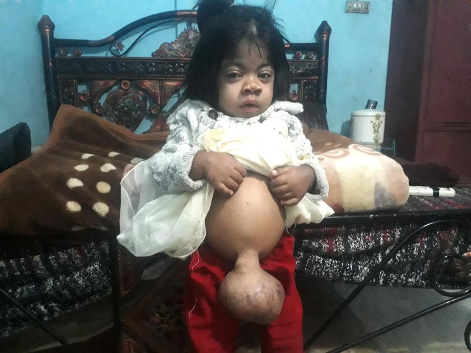  Fiza Channa suffers from an extreme case of umbilical hernia