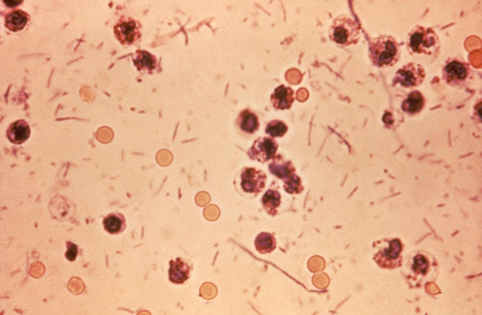 Shigellosis 