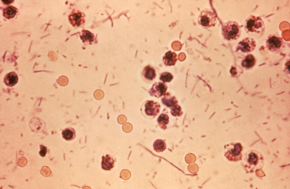  The Shigellosis vomiting bug has broken out at a school in Surrey