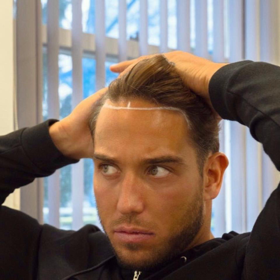  James Lock has undergone a hair transplant