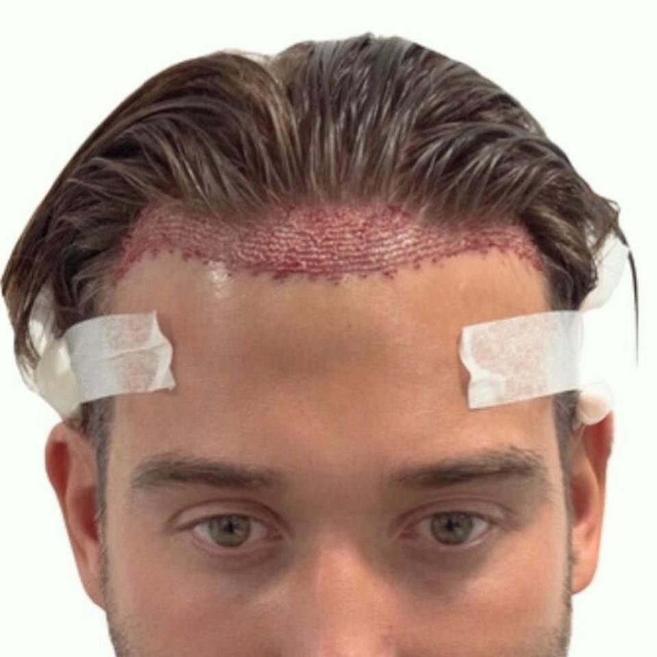  James shared a close up of his hair line after the procedure