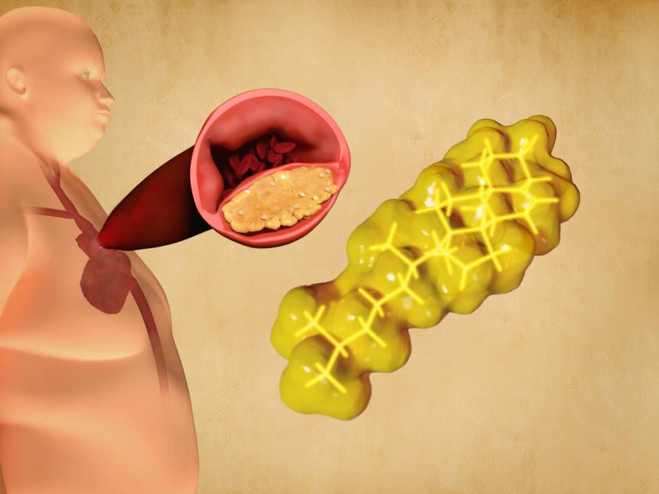  LDLs carry cholesterol to cells that require it, but if too much is delivered this can build up in artery walls, which can lead to heart disease