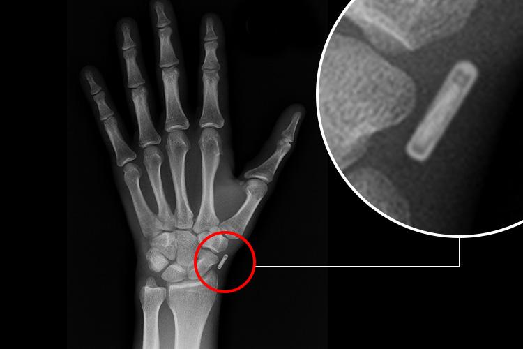  The X-ray which Noah says shows a device in his hand that helps him to time travel