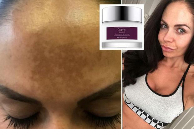 Harriet Metzger used £49 cream to treat sun damage to her forehead