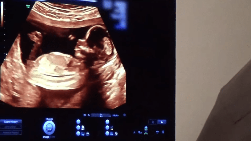  Kylie also shared the moment of her first scan