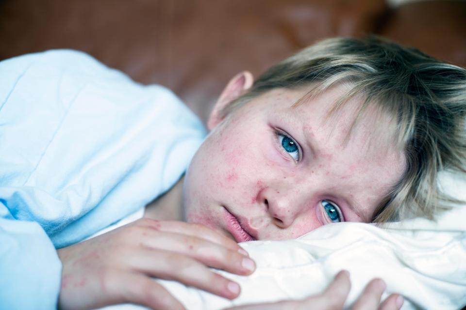  Measles starts with cold like symptoms before a rash develops a few days later