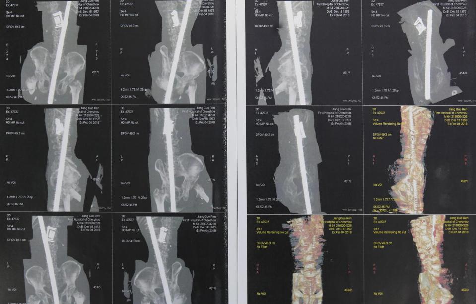 X-rays show the extent of the man's damage