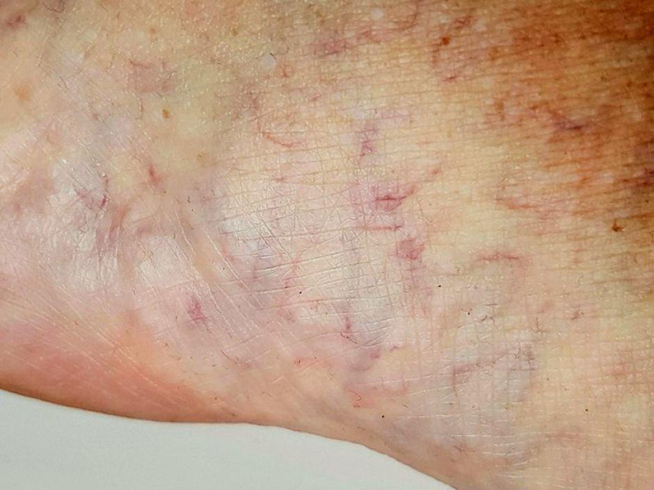  The worms left these vein-like track marks where they burrowed through her foot