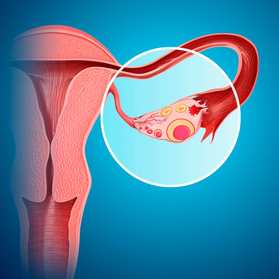 Polycystic ovary syndrome affects how much oestrogen a woman's body produces, which can cause excess body hair