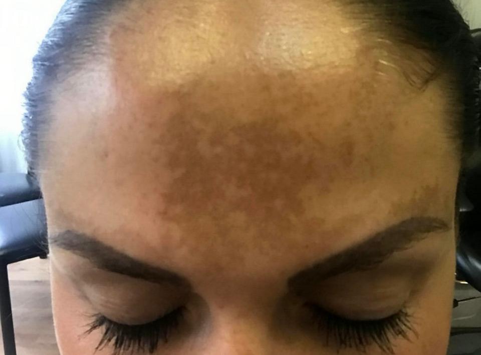  Harriet Metzger was left with brown patches on her forehead after years in the sun